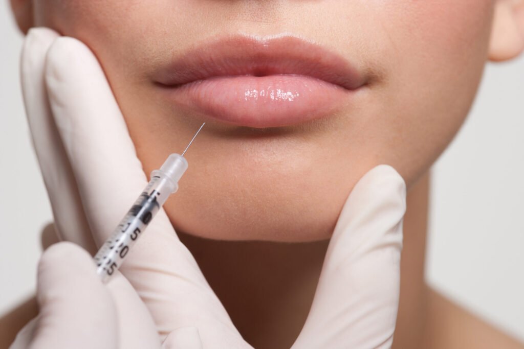 Lippenauffüllung mit Hyaluronsäure